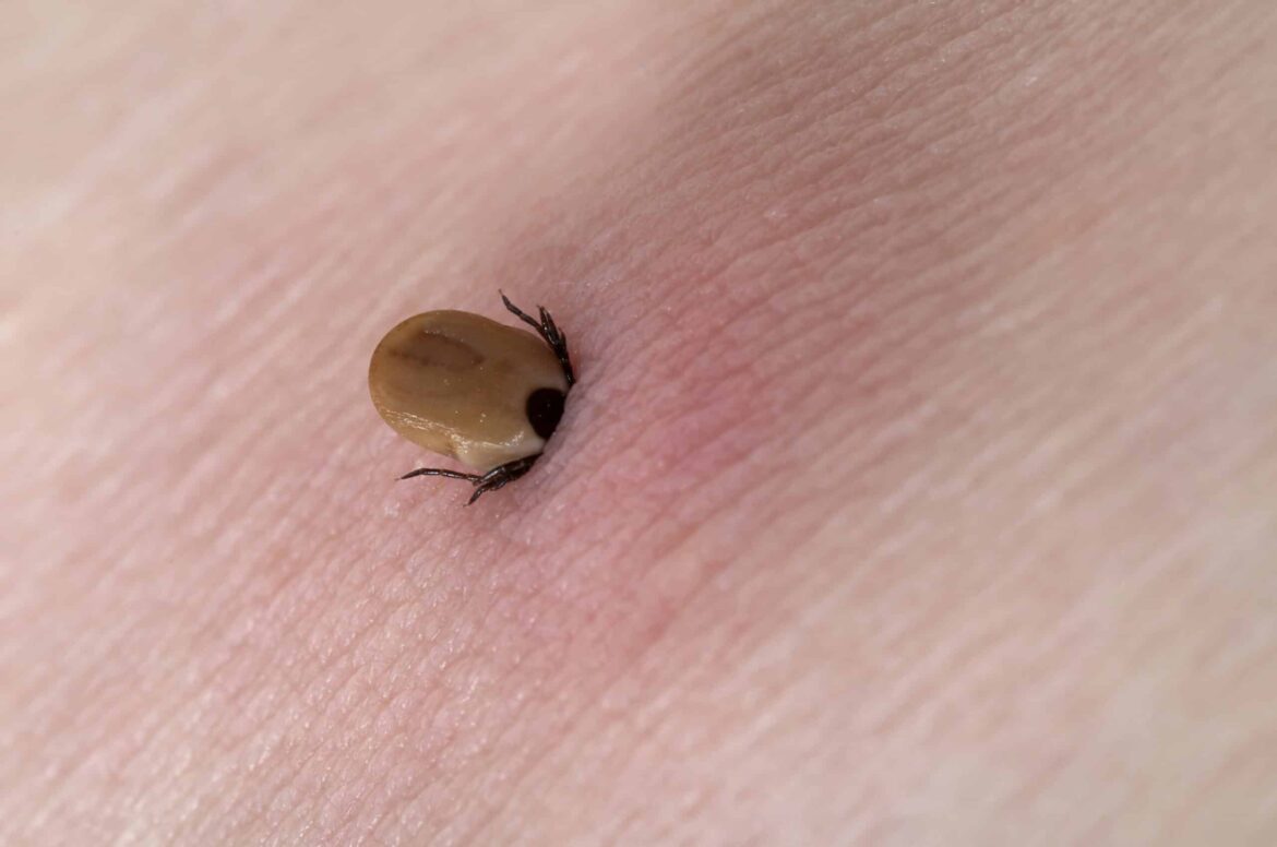 Tick stuck in the skin